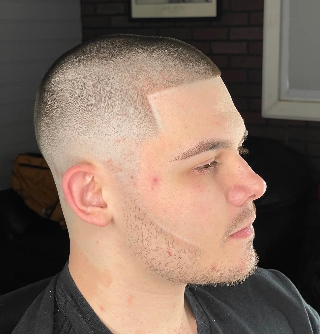 The same client after a buzz cut with the hairline cut in square and sharp